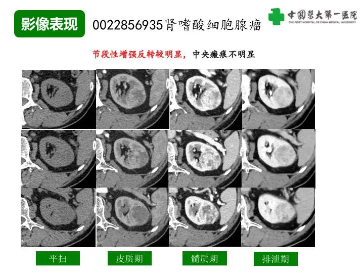 影像PPT - 【病例】肾脏嗜酸细胞腺瘤1例CT影像-20