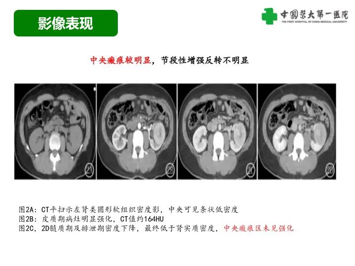影像PPT - 【病例】肾脏嗜酸细胞腺瘤1例CT影像-22