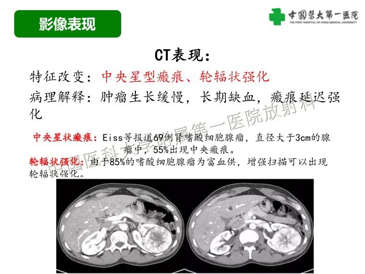 影像PPT - 【病例】肾脏嗜酸细胞腺瘤1例CT影像-17