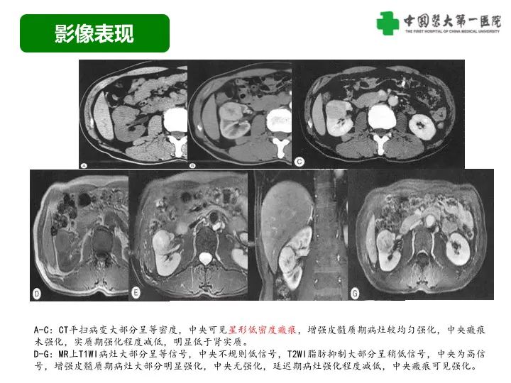 影像PPT - 【病例】肾脏嗜酸细胞腺瘤1例CT影像-24