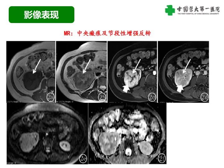 影像PPT - 【病例】肾脏嗜酸细胞腺瘤1例CT影像-25