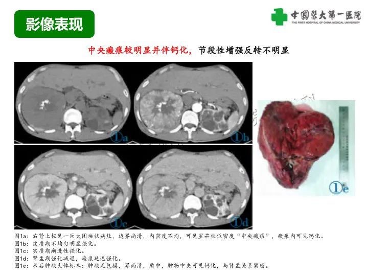影像PPT - 【病例】肾脏嗜酸细胞腺瘤1例CT影像-26