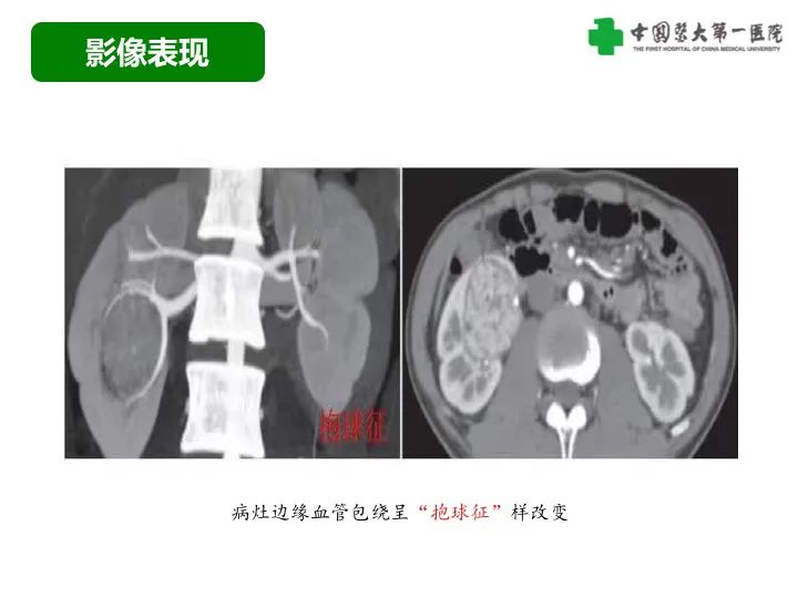 影像PPT - 【病例】肾脏嗜酸细胞腺瘤1例CT影像-27