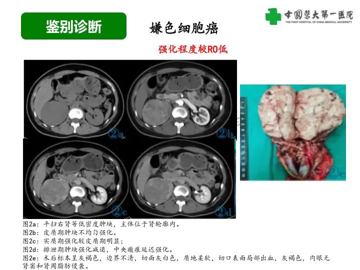 影像PPT - 【病例】肾脏嗜酸细胞腺瘤1例CT影像-30