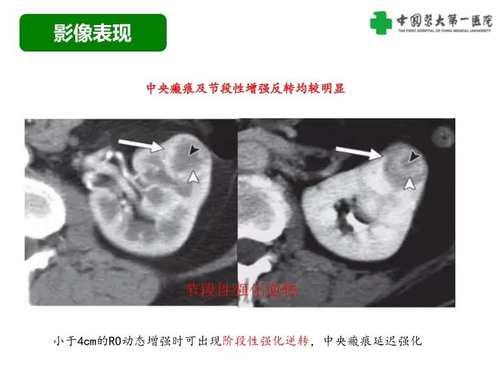 影像PPT - 【病例】肾脏嗜酸细胞腺瘤1例CT影像-23