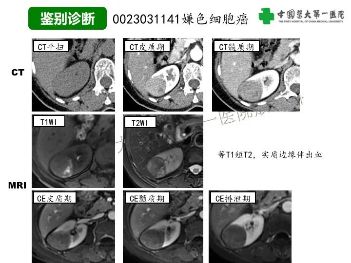 影像PPT - 【病例】肾脏嗜酸细胞腺瘤1例CT影像-32