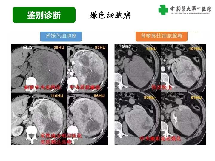 影像PPT - 【病例】肾脏嗜酸细胞腺瘤1例CT影像-33