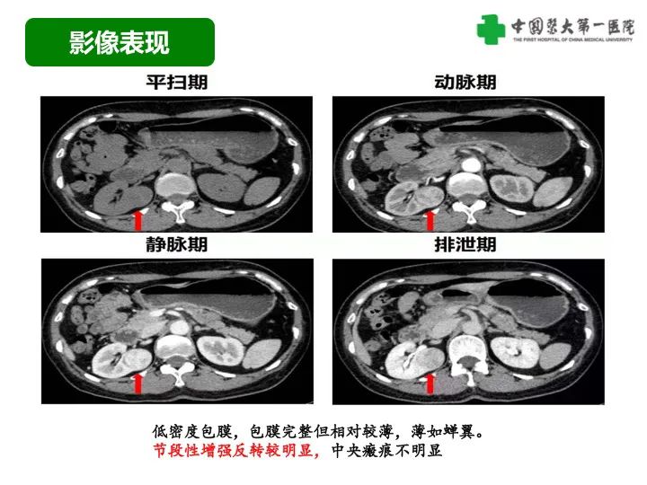影像PPT - 【病例】肾脏嗜酸细胞腺瘤1例CT影像-21