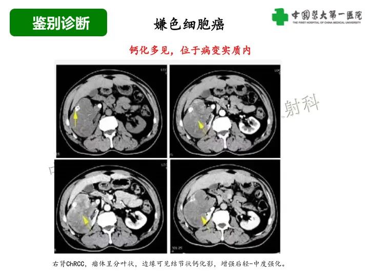影像PPT - 【病例】肾脏嗜酸细胞腺瘤1例CT影像-31