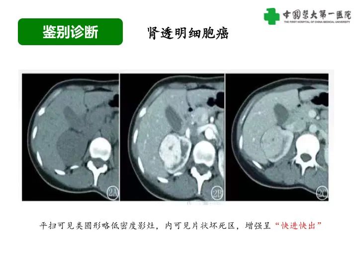 影像PPT - 【病例】肾脏嗜酸细胞腺瘤1例CT影像-37