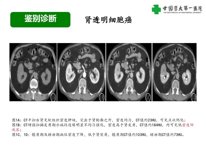 影像PPT - 【病例】肾脏嗜酸细胞腺瘤1例CT影像-36