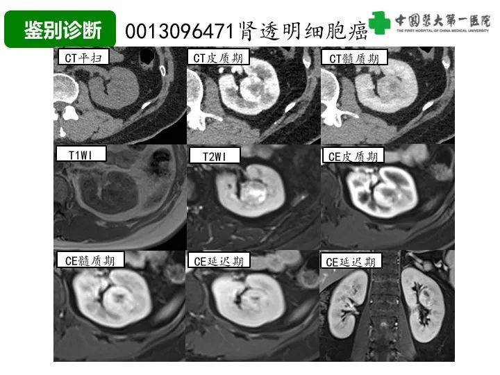 影像PPT - 【病例】肾脏嗜酸细胞腺瘤1例CT影像-35
