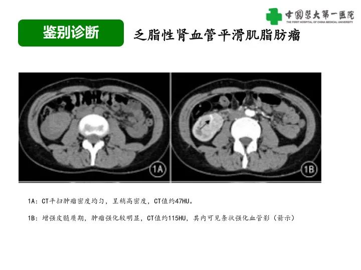 影像PPT - 【病例】肾脏嗜酸细胞腺瘤1例CT影像-39