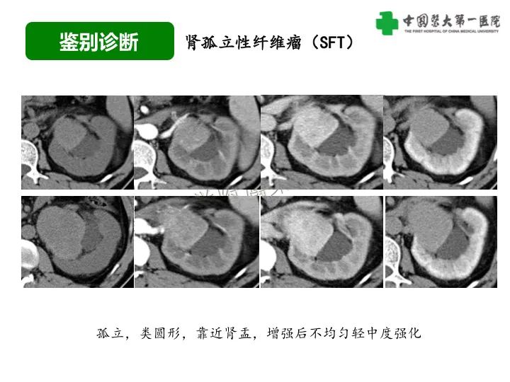 影像PPT - 【病例】肾脏嗜酸细胞腺瘤1例CT影像-42