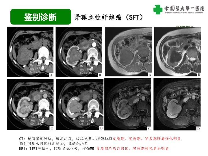 影像PPT - 【病例】肾脏嗜酸细胞腺瘤1例CT影像-43