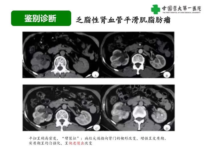 影像PPT - 【病例】肾脏嗜酸细胞腺瘤1例CT影像-40