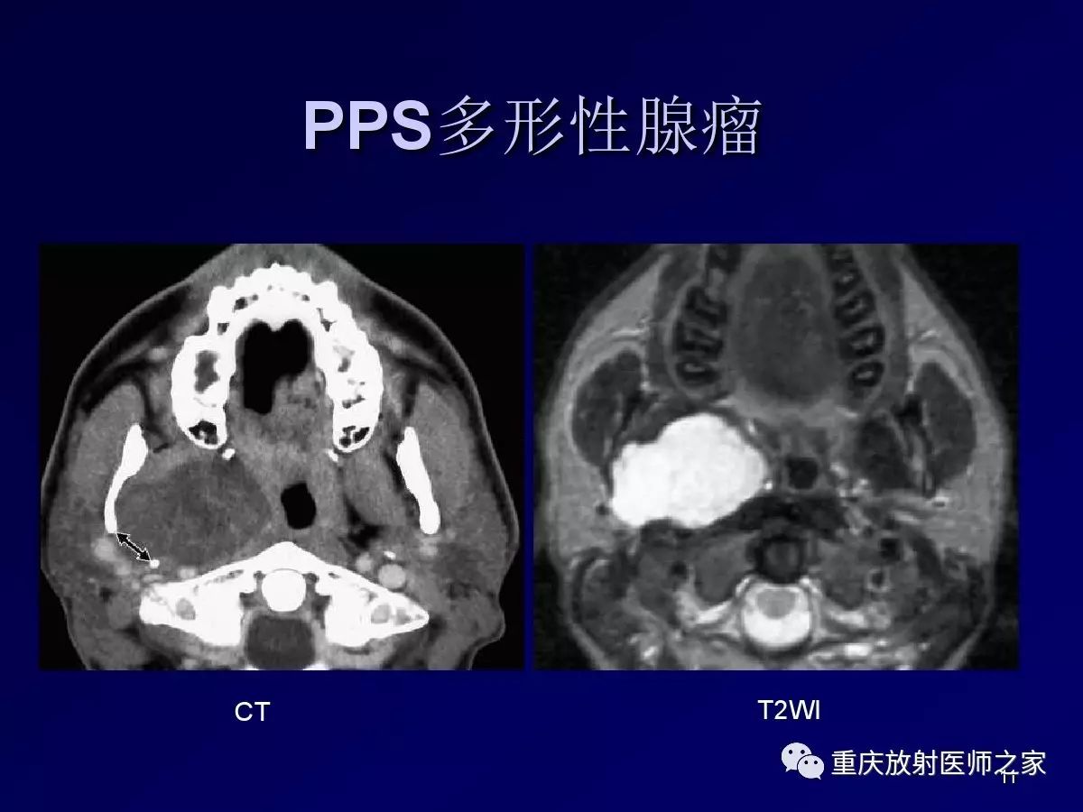 影像PPT - 【PPT】颈部病变的诊断思路-11