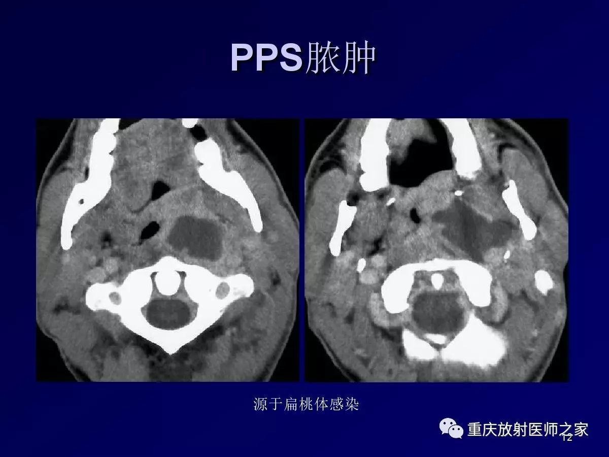 影像PPT - 【PPT】颈部病变的诊断思路-12