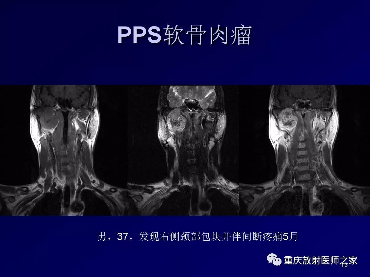 影像PPT - 【PPT】颈部病变的诊断思路-13