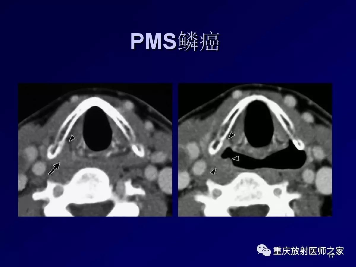 影像PPT - 【PPT】颈部病变的诊断思路-17