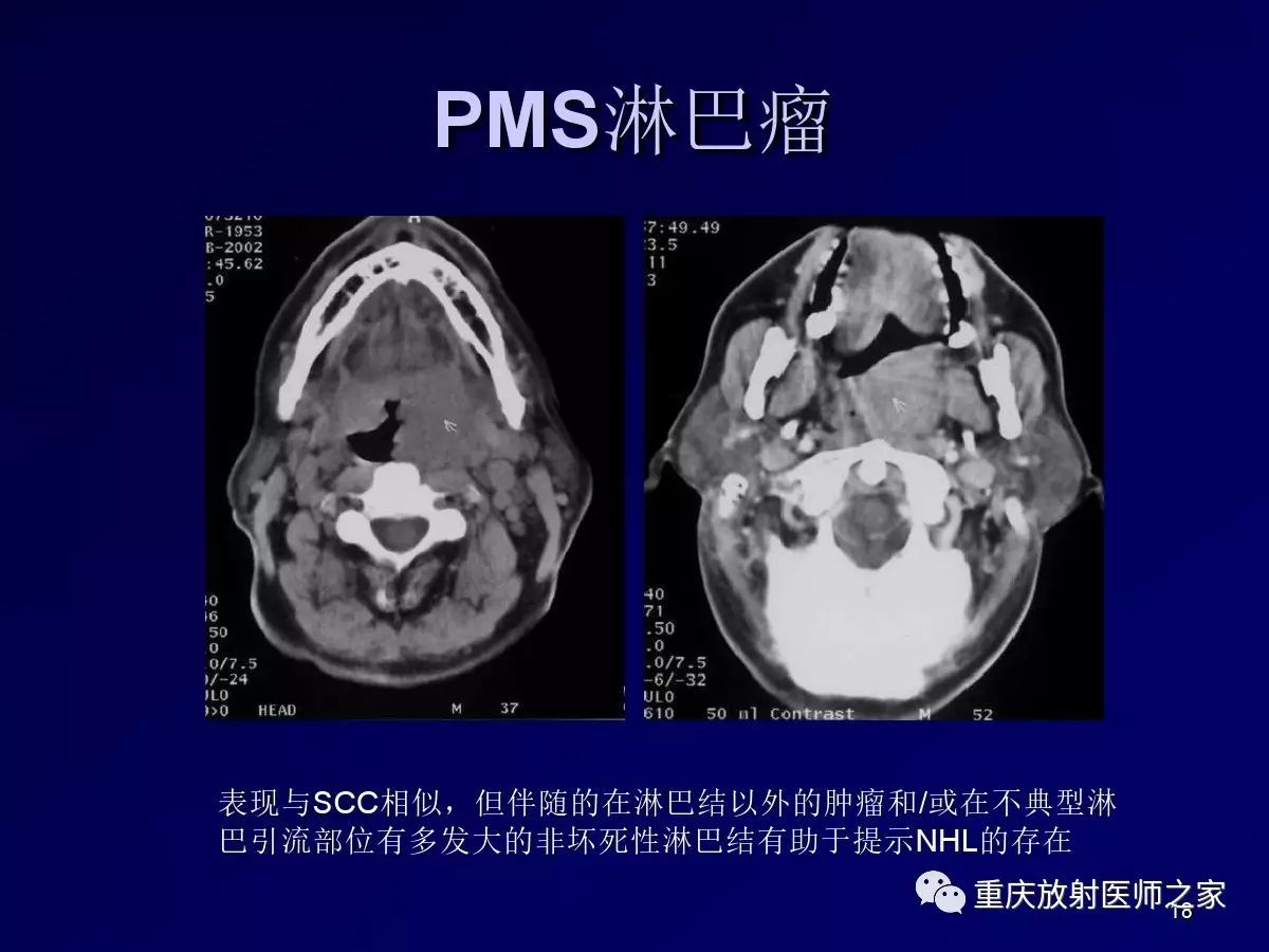 影像PPT - 【PPT】颈部病变的诊断思路-18