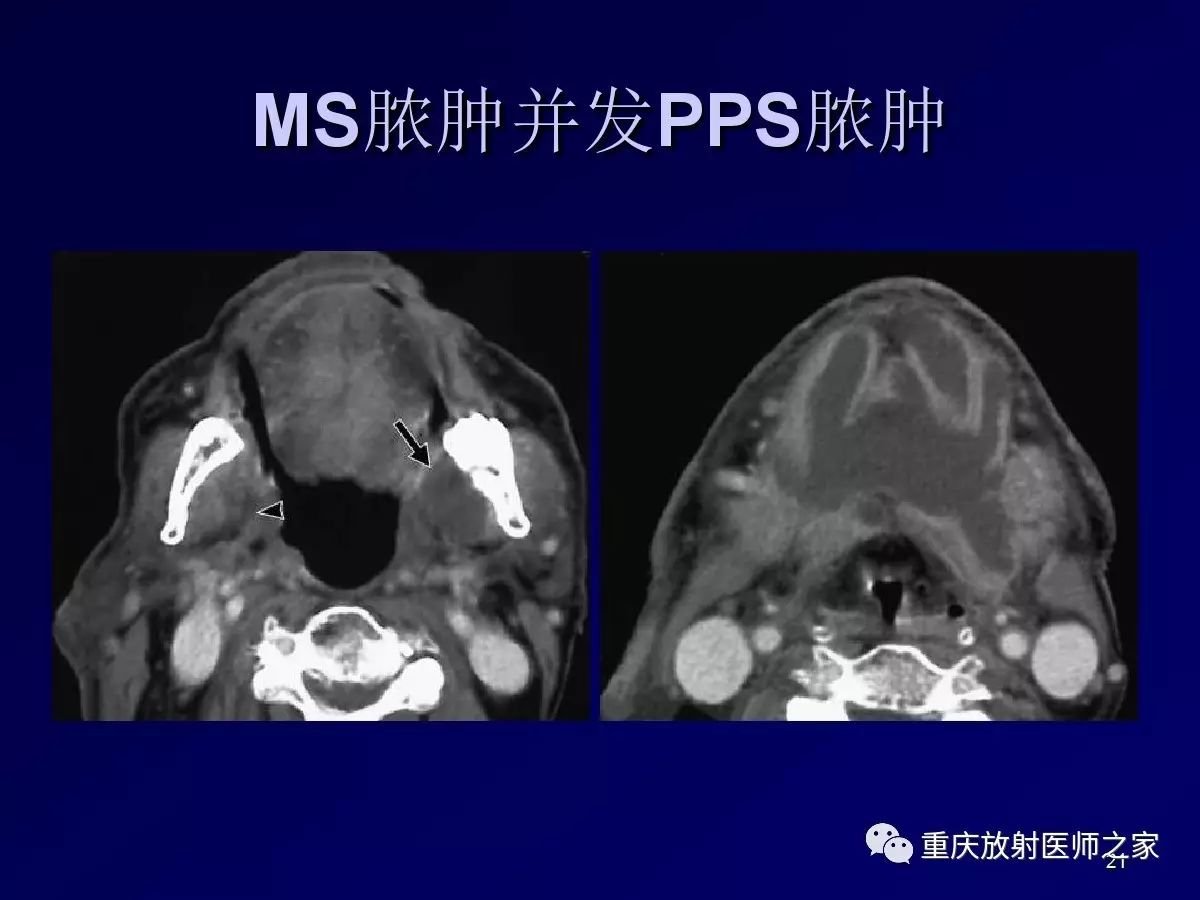 影像PPT - 【PPT】颈部病变的诊断思路-21