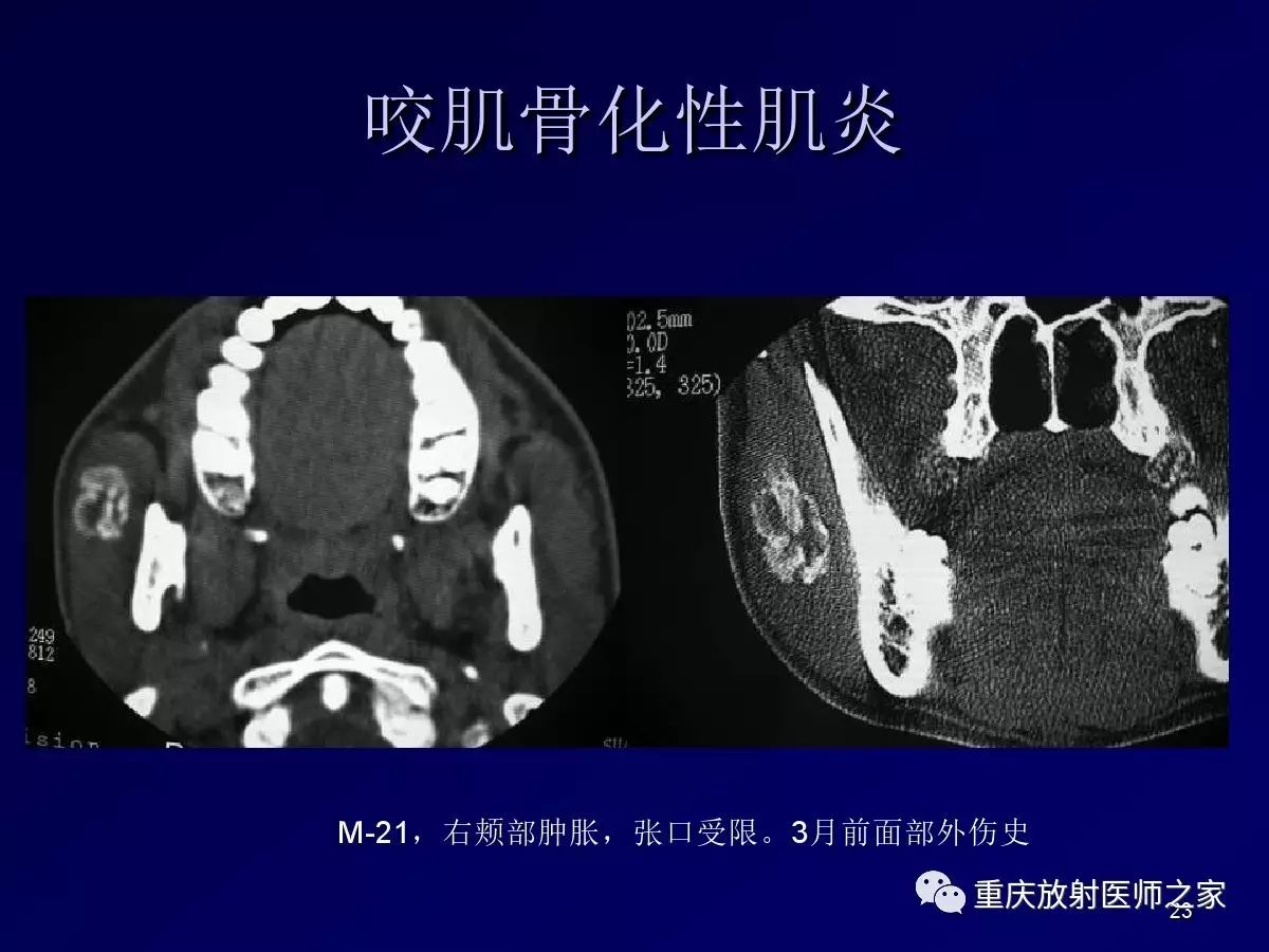 影像PPT - 【PPT】颈部病变的诊断思路-23
