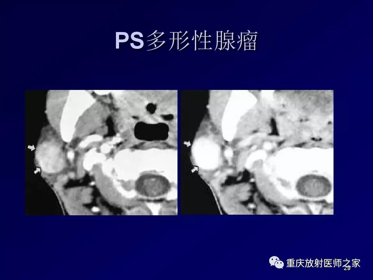 影像PPT - 【PPT】颈部病变的诊断思路-29