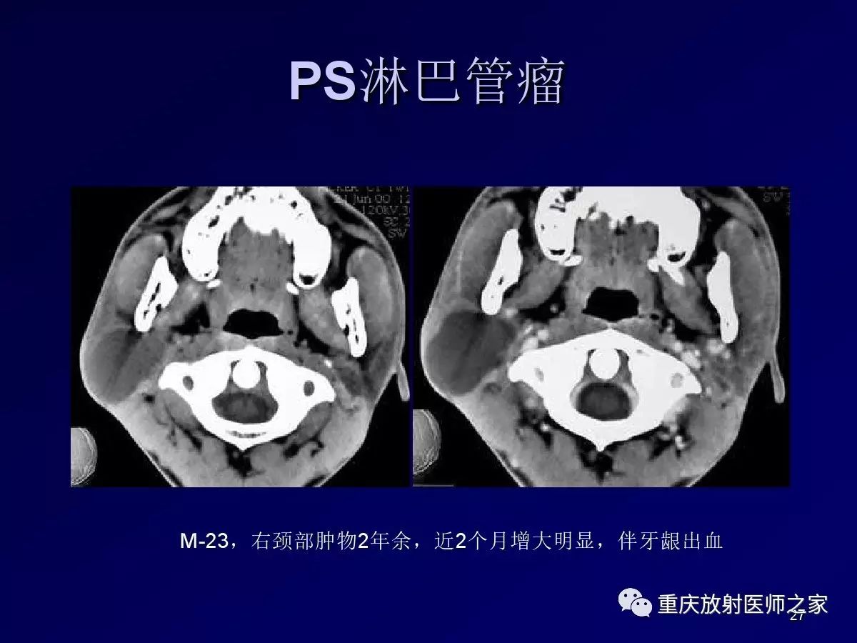 影像PPT - 【PPT】颈部病变的诊断思路-27