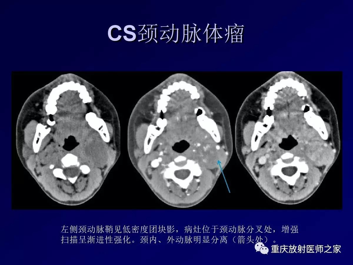 影像PPT - 【PPT】颈部病变的诊断思路-34