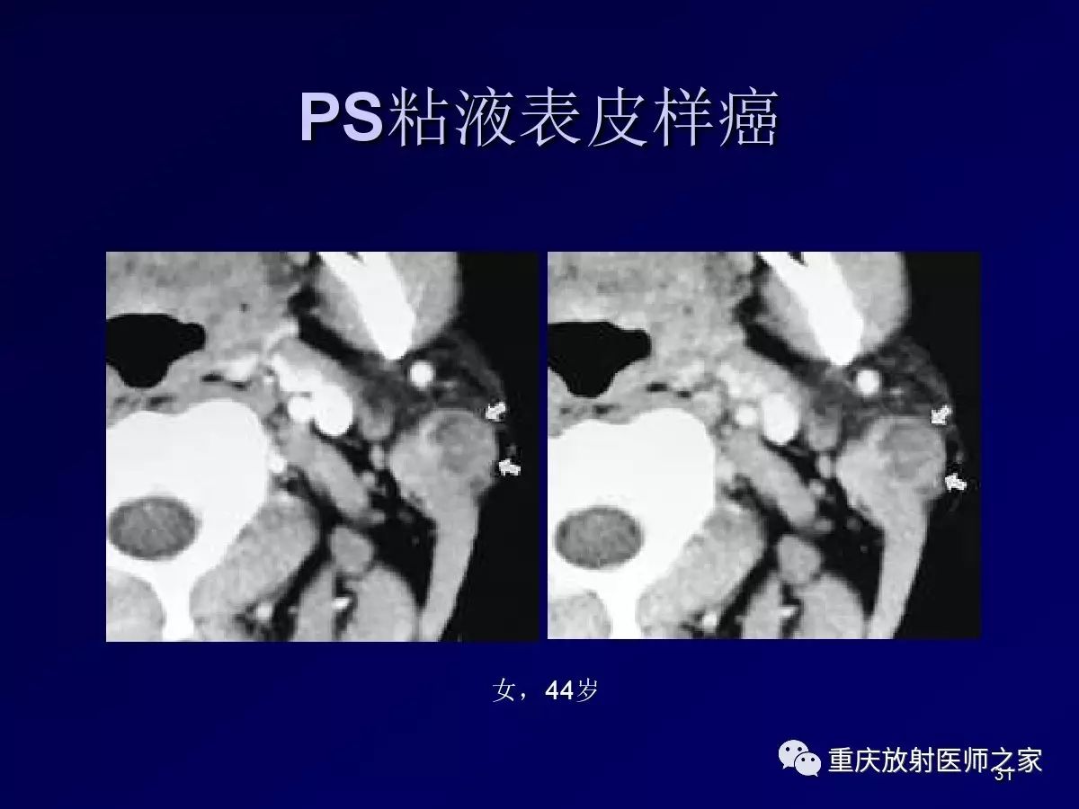 影像PPT - 【PPT】颈部病变的诊断思路-31