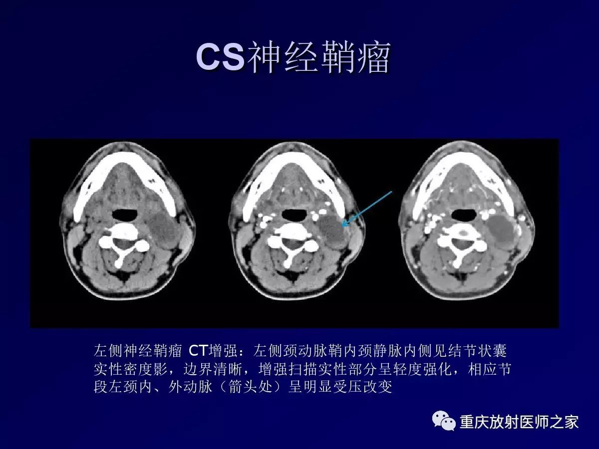 影像PPT - 【PPT】颈部病变的诊断思路-37