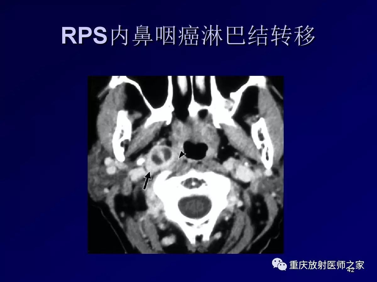 影像PPT - 【PPT】颈部病变的诊断思路-42