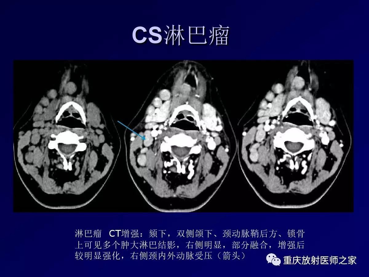 影像PPT - 【PPT】颈部病变的诊断思路-38