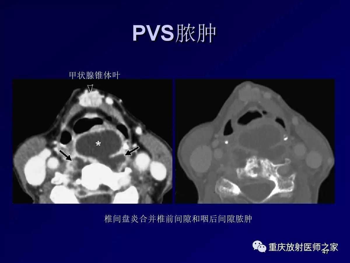 影像PPT - 【PPT】颈部病变的诊断思路-47