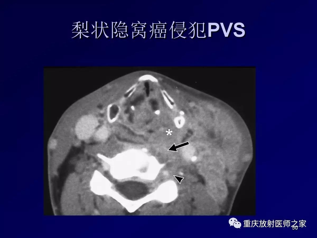 影像PPT - 【PPT】颈部病变的诊断思路-50