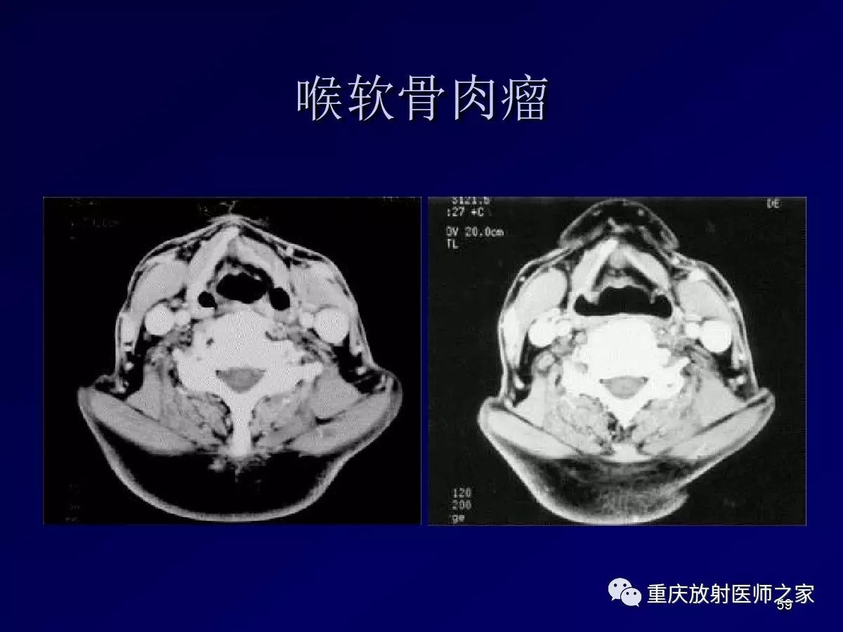 影像PPT - 【PPT】颈部病变的诊断思路-59