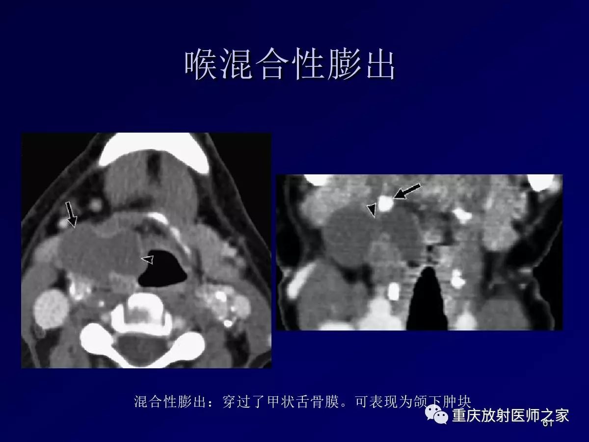 影像PPT - 【PPT】颈部病变的诊断思路-61