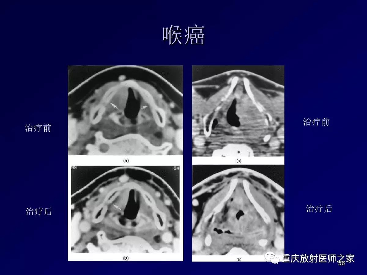 影像PPT - 【PPT】颈部病变的诊断思路-58