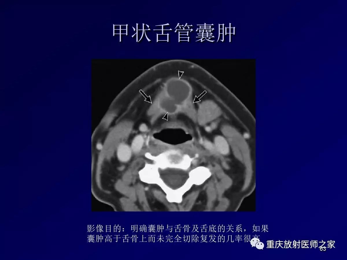 影像PPT - 【PPT】颈部病变的诊断思路-63