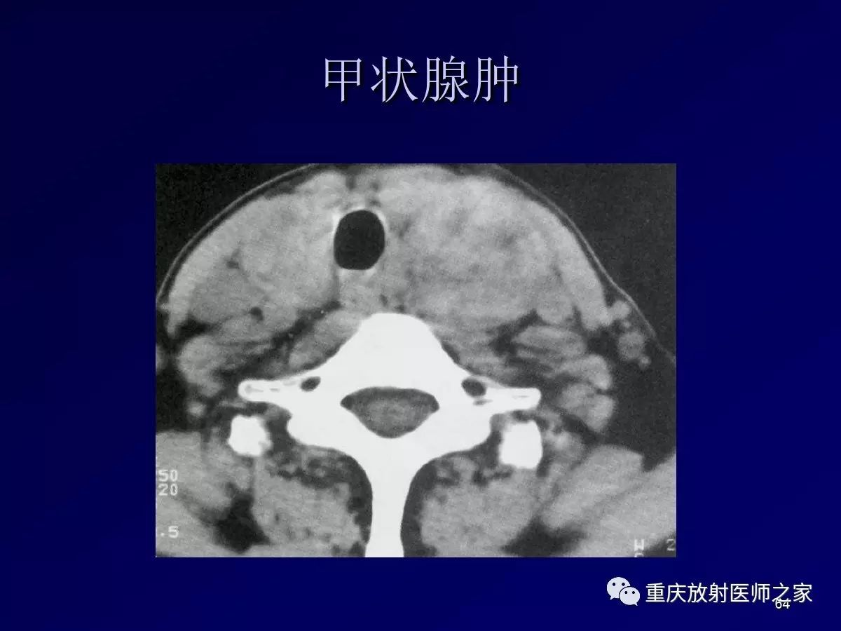 影像PPT - 【PPT】颈部病变的诊断思路-64