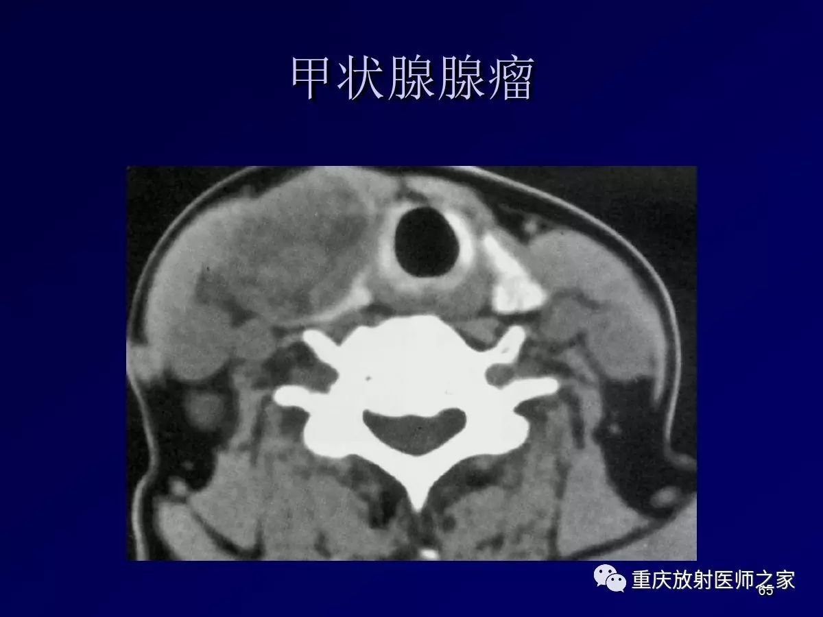 影像PPT - 【PPT】颈部病变的诊断思路-65
