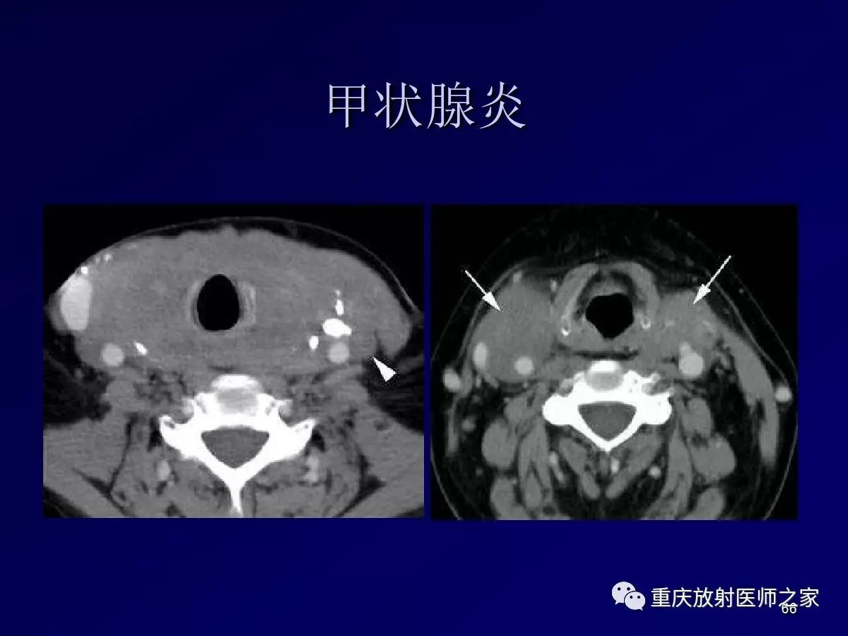 影像PPT - 【PPT】颈部病变的诊断思路-66