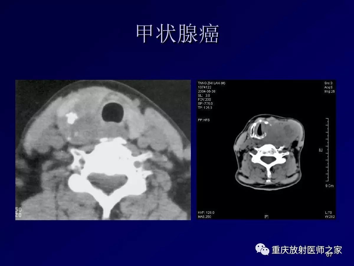 影像PPT - 【PPT】颈部病变的诊断思路-67