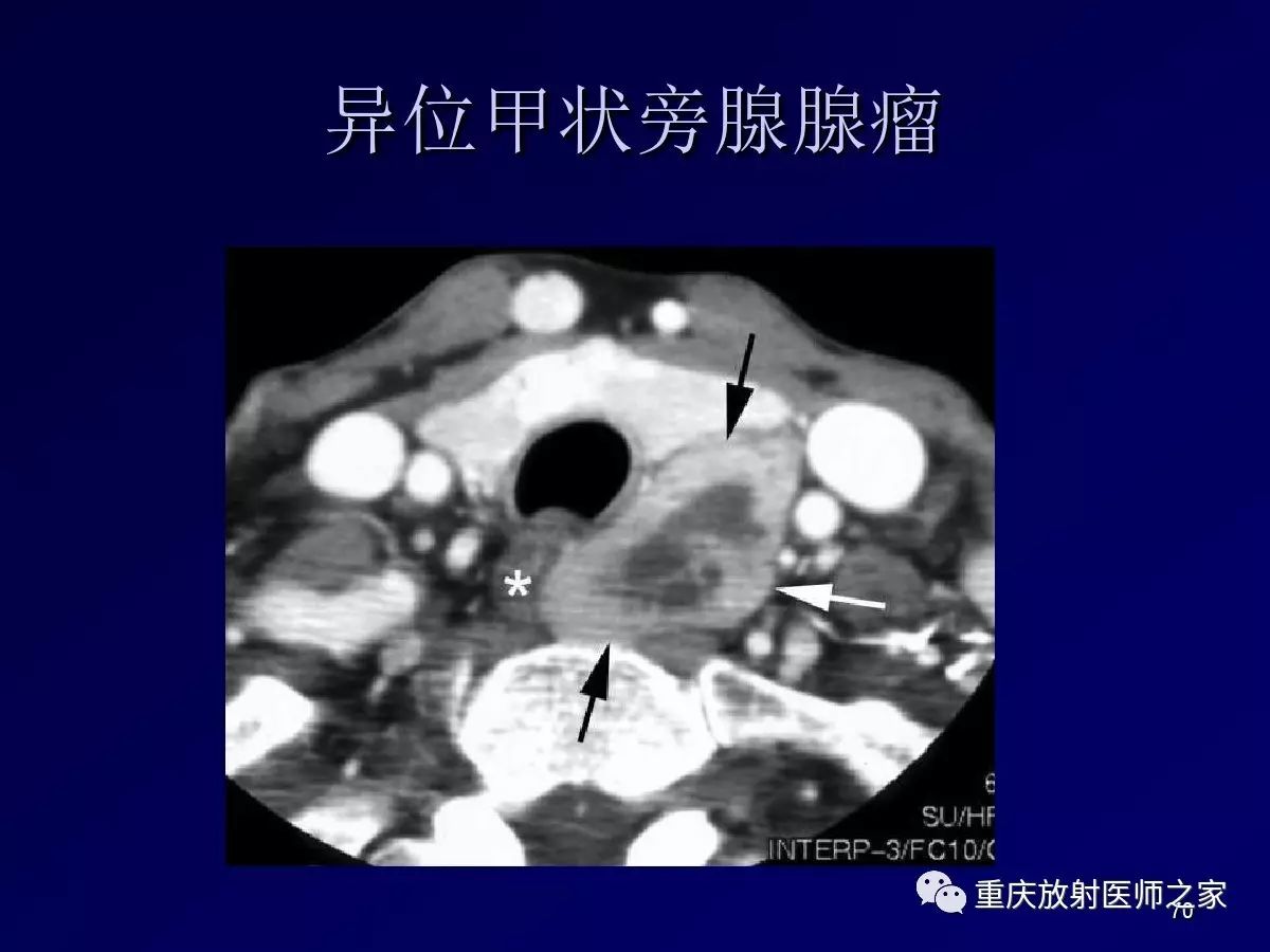 影像PPT - 【PPT】颈部病变的诊断思路-70
