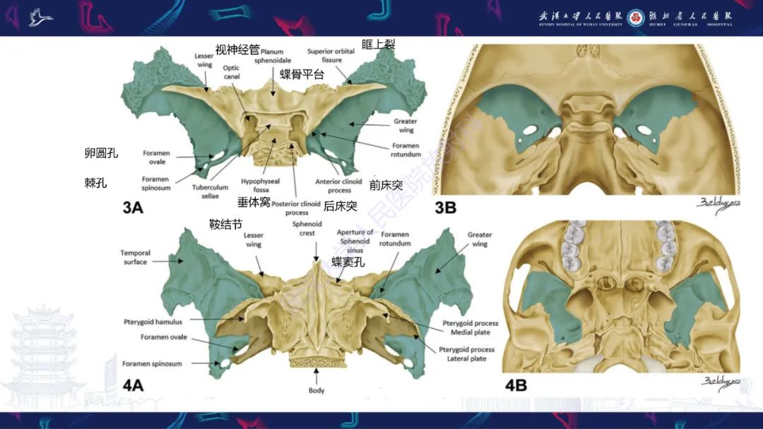 影像PPT - 【PPT】蝶骨大翼病变影像诊断-5