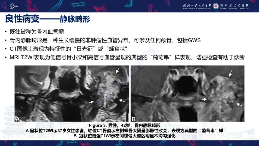 影像PPT - 【PPT】蝶骨大翼病变影像诊断-11