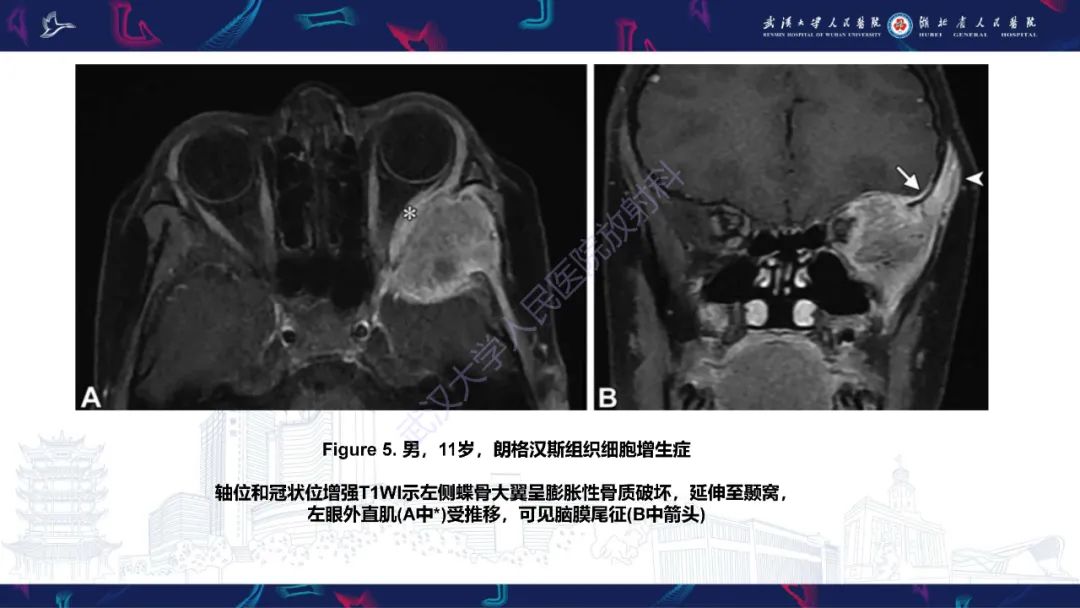 影像PPT - 【PPT】蝶骨大翼病变影像诊断-15