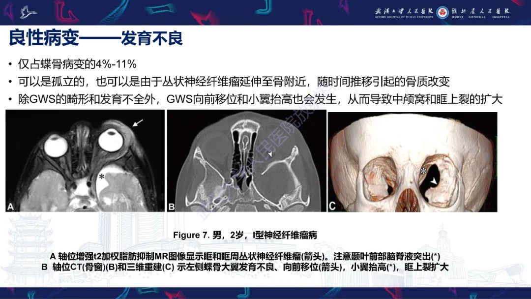 影像PPT - 【PPT】蝶骨大翼病变影像诊断-18