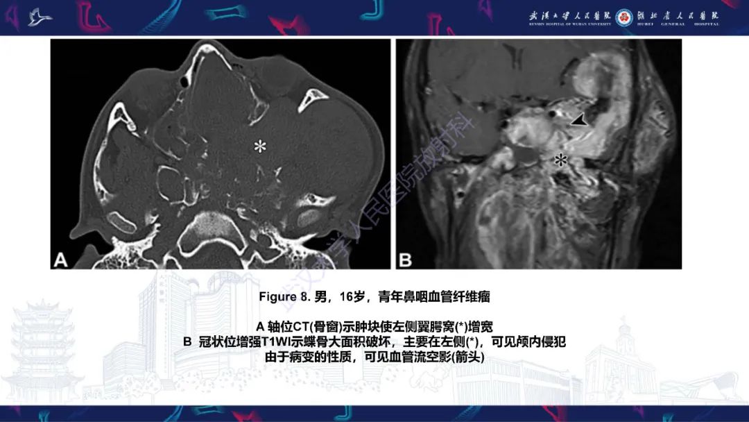 影像PPT - 【PPT】蝶骨大翼病变影像诊断-20